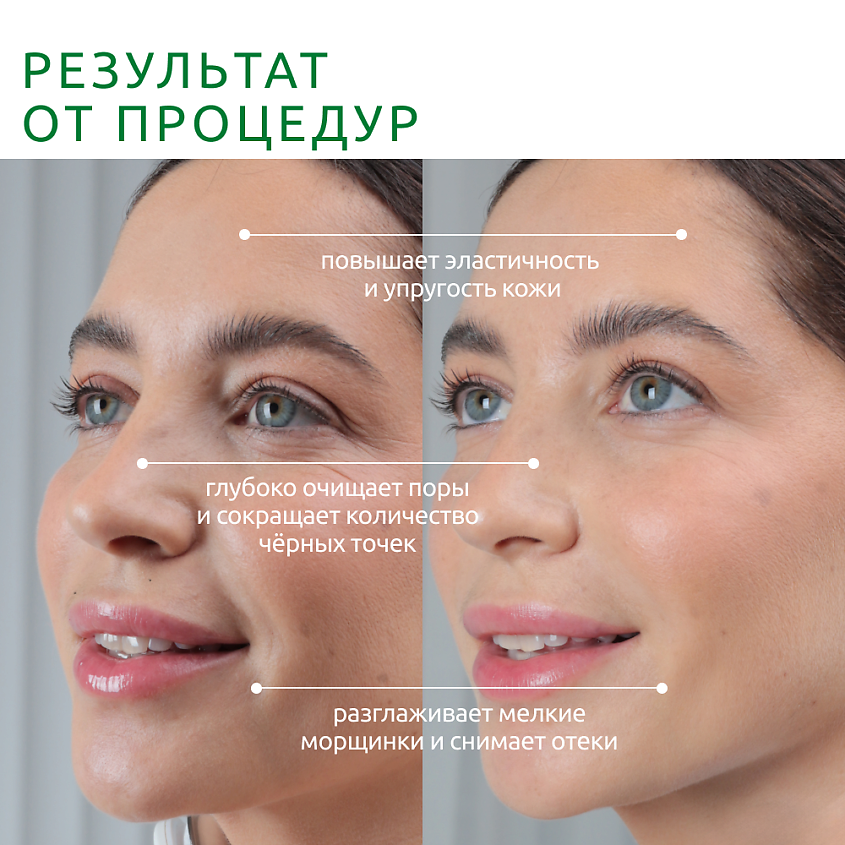 READYSKIN Аппарат для ультразвуковой чистки лица ZY8300, микротоки, ионофорез, термомассаж, лифтинг, цвет: Голубой – фото 8