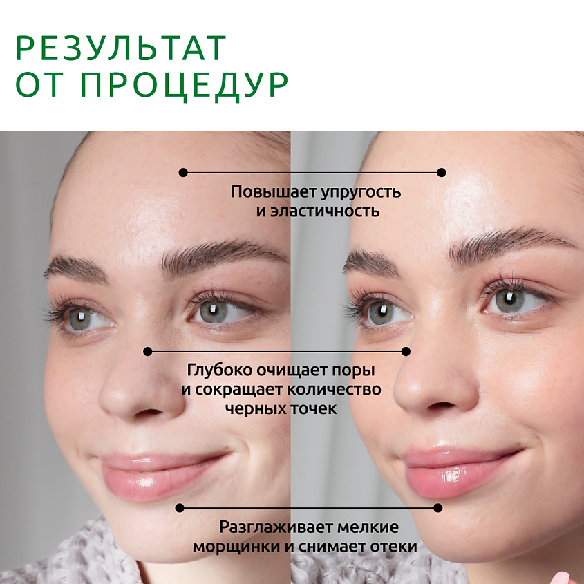 READYSKIN Аппарат для ультразвуковой чистки лица, микротоков, EMS-лифтинга Nova – фото 2