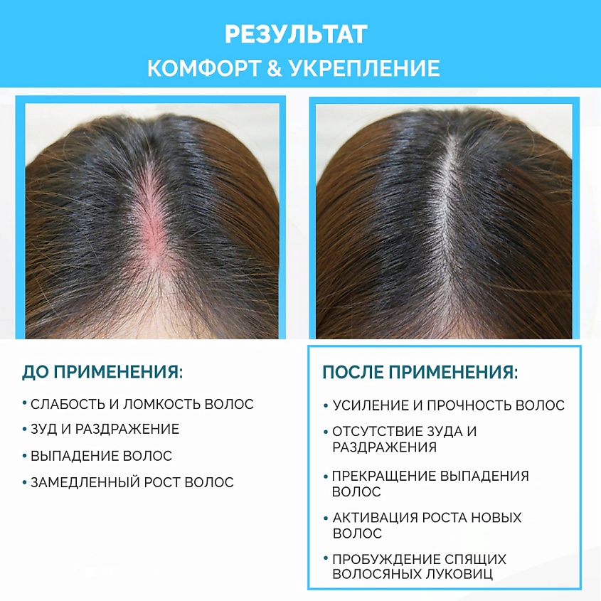 РИНФОЛТИЛ PRO Спрей для волос от выпадения для чувствительной кожи головы – фото 9
