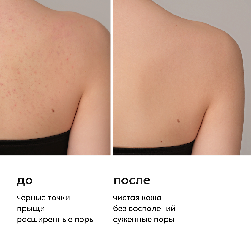 LIKATO Гель для душа от прыщей на теле ACNE CONTROL – фото 3