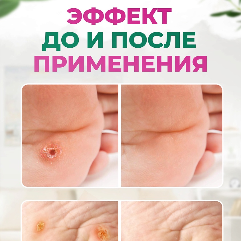 LUXPLAST Лейкопластырь от сухих мозолей на полимерной основе 6 штук – фото 5